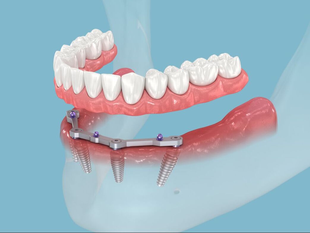 prothèse dentaire sur implant all on four