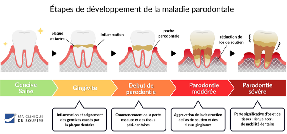 différentes étapes des problèmes de parodontie