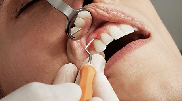 soin de la gencive: traitement parodontaux