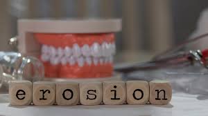 L'érosion dentaire résulte de l'exposition de vos dents à des acides, qu'ils proviennent de votre alimentation ou de votre estomac